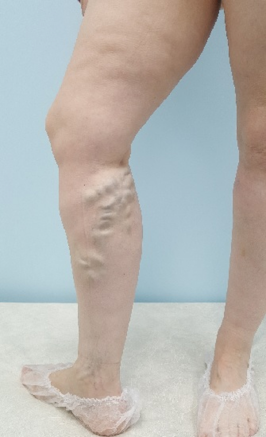 Венозные узлы на ногах и уплотнения на венах